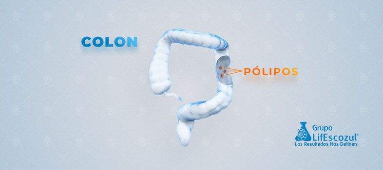 Cáncer de colon