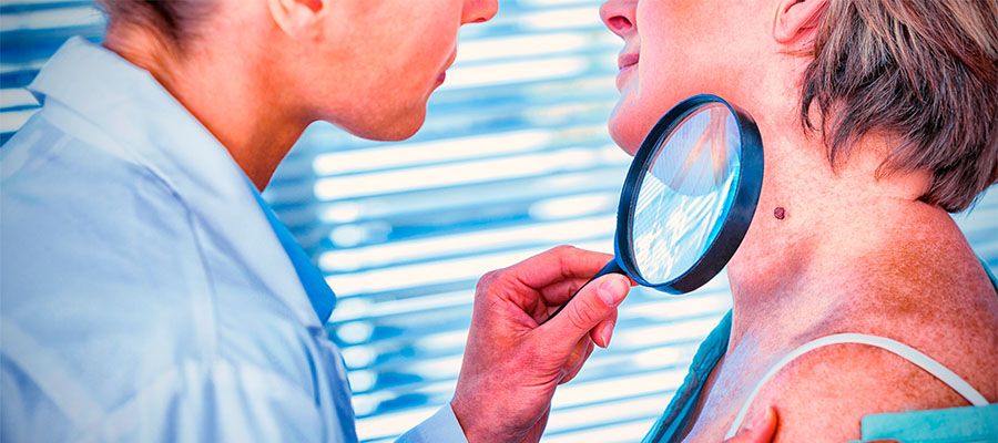consumo-de-alcohol-y-cancer-melanoma-vida-y-salud
