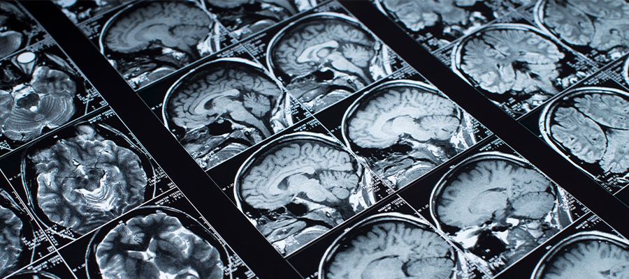 beneficios-del-ayuno-glioblastoma-cancer-cerebral